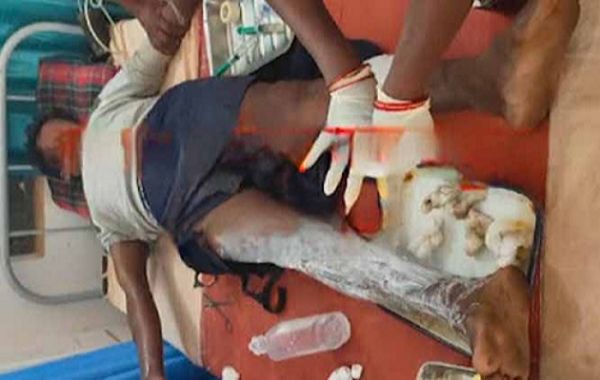 नक्सलियों द्वारा लगाए गए प्रेसर आईईडी विस्फोट में श्रमिक घायल