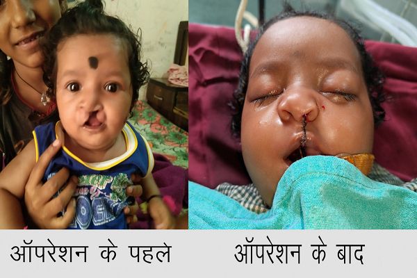 चिरायु योजना ने लौटाई मासूमों की मुस्कान