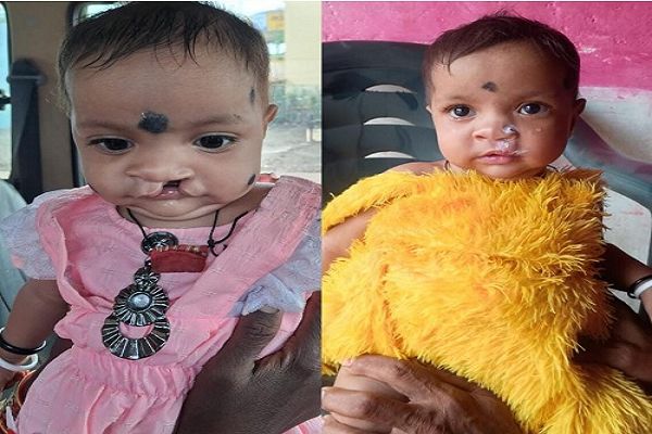 चिरायु योजना बनी बच्चों के लिए जीवनदायिनी